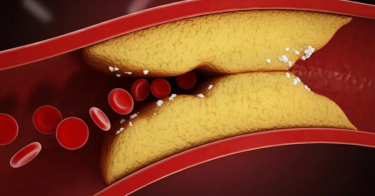 Como reduzir a gordura nas artérias: médico vascular revela estratégias comprovadas para proteger o coração