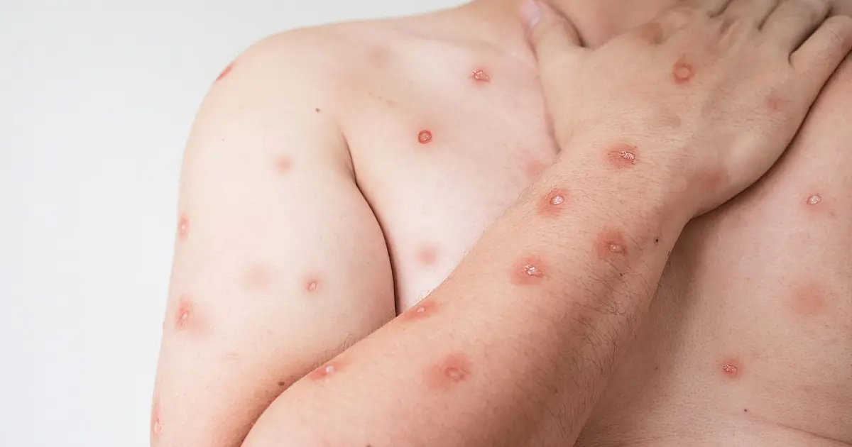 Imagem ilustrativa mostra lesões na pele associadas à mpox em paciente adulto.