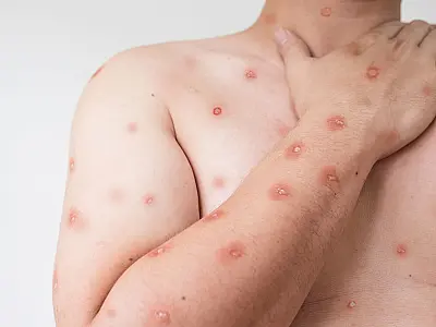 Casos de mpox no Brasil somam 88 confirmações em 2026, segundo o Ministério da Saúde.