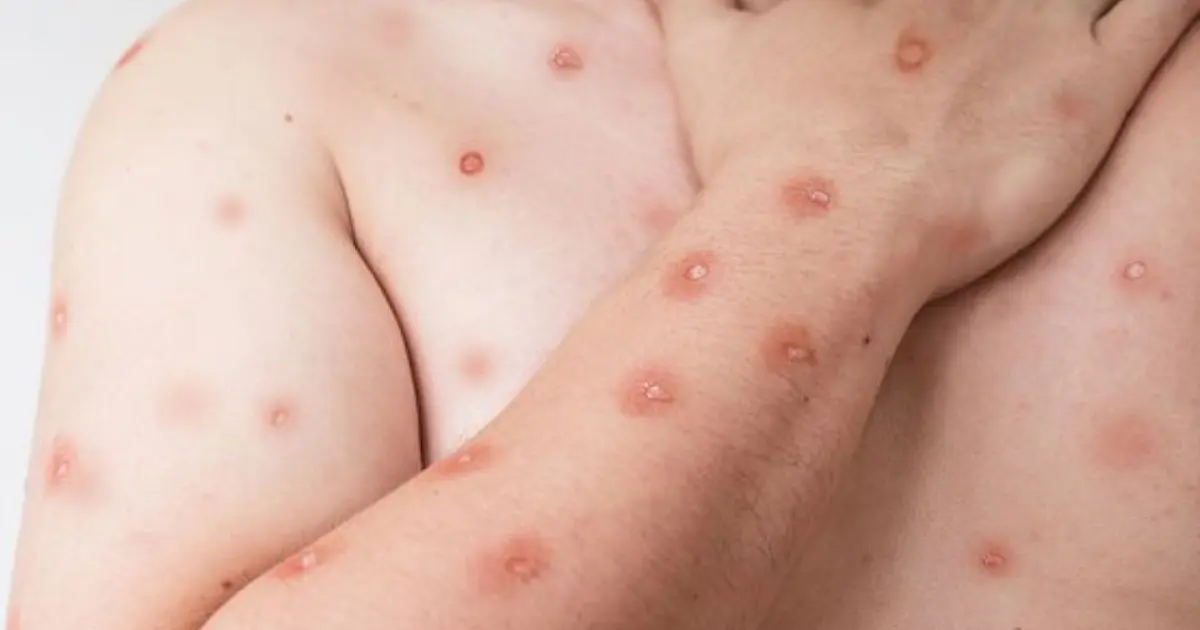 Fachada do Ministério da Saúde com destaque para ações de vigilância da mpox