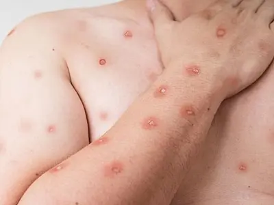 Ministério da Saúde reforça monitoramento e diagnóstico da mpox pelo SUS.