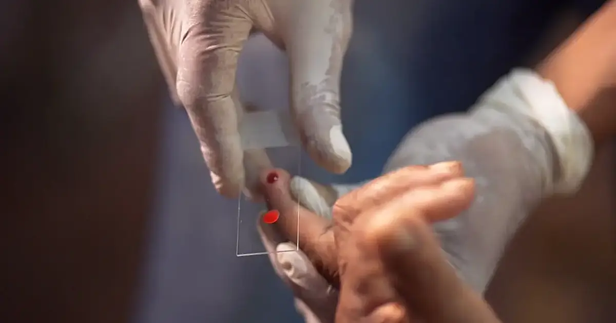 SUS começa a usar novo tratamento contra malária em crianças com dose única e foco na Amazônia Legal