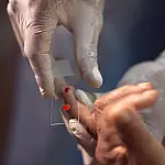 SUS começa a usar novo tratamento contra malária em crianças com dose única e foco na Amazônia Legal