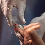 SUS inicia novo tratamento contra malária em crianças no Brasil