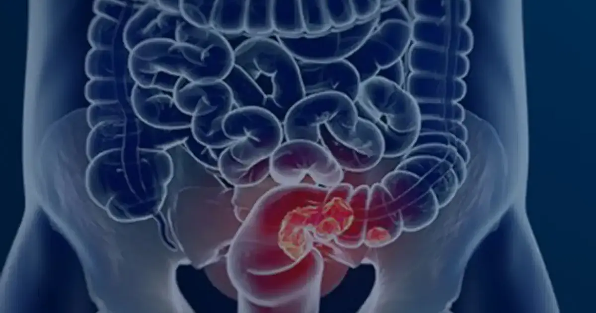 SUS avalia rastreamento do câncer colorretal para ampliar prevenção e antecipar diagnóstico no Brasil