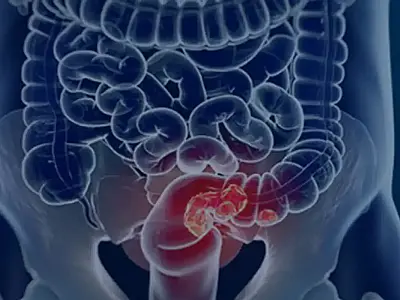 SUS analisa adoção de rastreamento do câncer colorretal com exame periódico e possível ampliação do diagnóstico precoce e da prevenção.
