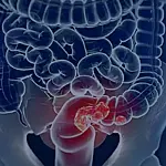 SUS avalia rastreamento do câncer colorretal para ampliar prevenção e antecipar diagnóstico no Brasil