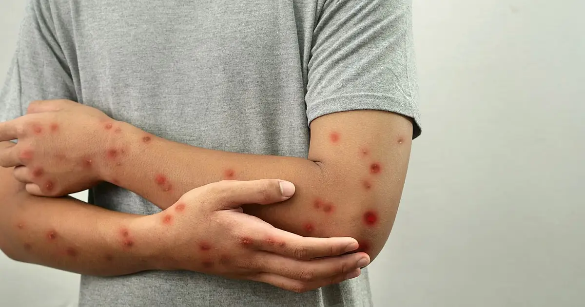 Pessoa com lesões na pele causadas pela Mpox
