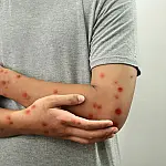 Mpox volta ao radar da saúde pública em 2026