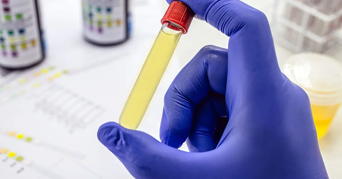 Frasco para exame toxicológico sendo segurado por profissional de saúde com luva.