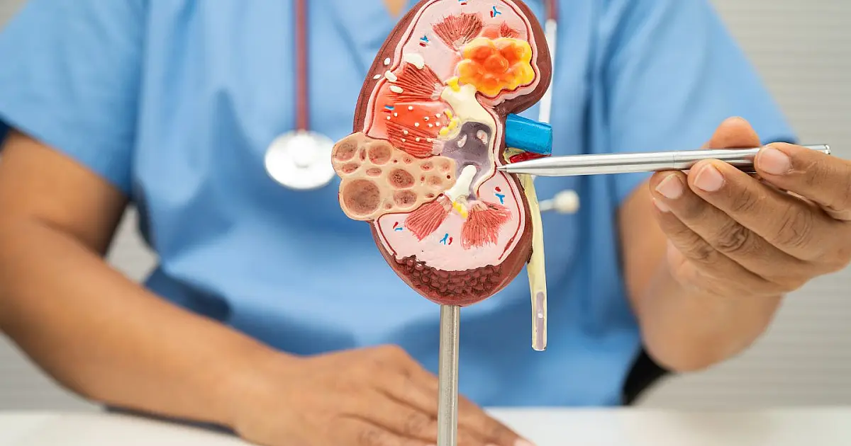 Médico segurando modelo anatômico dos rins durante explicação sobre cálculos renais