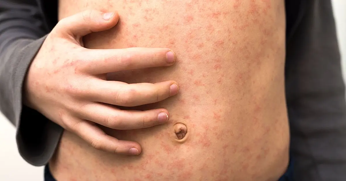 Criança com manchas vermelhas na pele representando sintomas do sarampo.