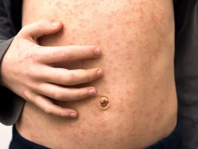 Brasil reforça vacinação diante do risco de sarampo após a Copa do Mundo.