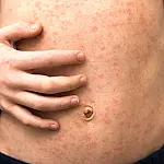 Brasil entra em alerta para risco de sarampo após Copa do Mundo