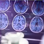 Spray nasal experimental desenvolvido nos EUA apresenta avanços contra o Alzheimer