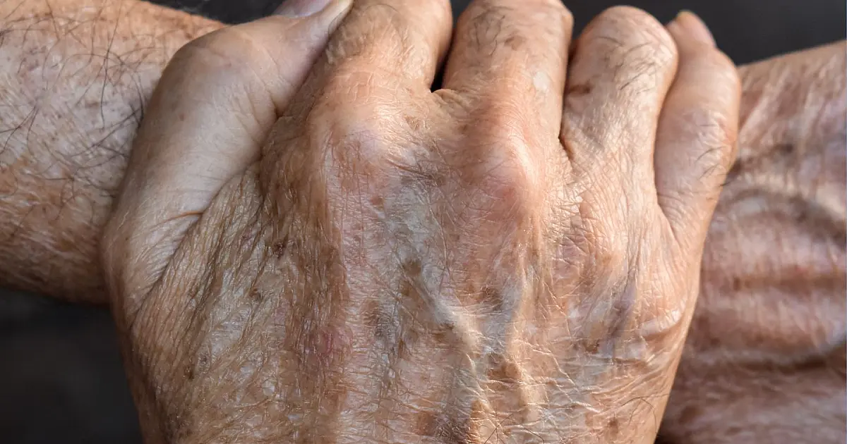 Foto em plano detalhe focada nas mãos de uma pessoa idosa, exibindo rugas e pequenas manchas escuras senis espalhadas sobre a pele